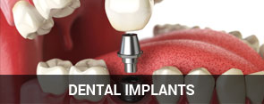 Dental Implants