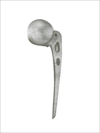 Austin Moore's Hip Prosthesis