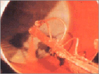 Polyurethane Elastomer Coating