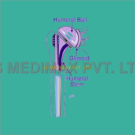 Modular Shoulder Prostheses