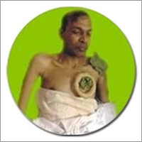 Management of Cancer by Mathuropathy & Alternative