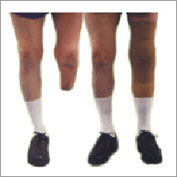 Below Knee Artificial Limb