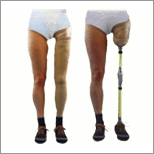 Above Knee Artificial Limb