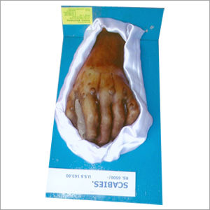 Scabies Model