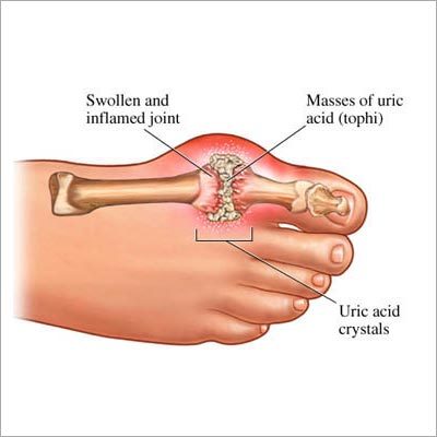 Gout Disease Treatment