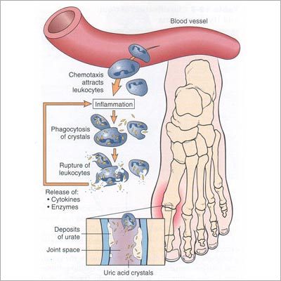 Gout Disease Homeopathic Treatment