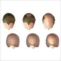 Hair Loss Homeopathy