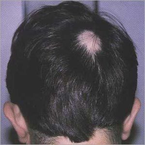 Hair Fall Homeopathic Treatment