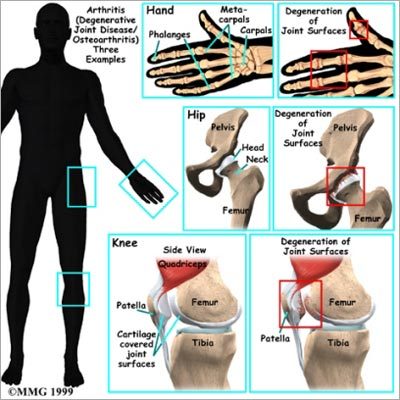 Joint Pain Homeopathy Treatment By RELICURE HOMEOPATHY CLINIC