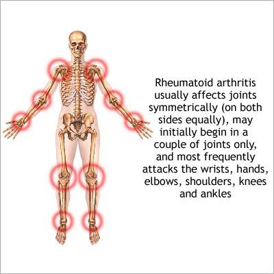 Joint Diseases Homeopathy Treatment