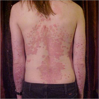 Skin Homeopathic Treatment