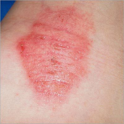 Skin Homeopathy Treatment