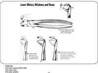Lower Molars , Wisdoms and Roots