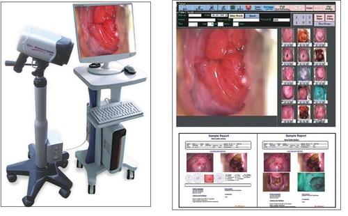 Digital Video Colposcope