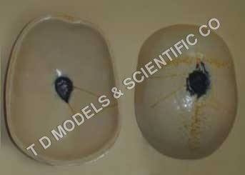 Exit Hole in Skull by Bullet