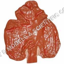 Stomach poisoned by oxalic acid
