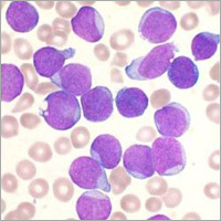Acute Leukemia Ayurvedic Therapy