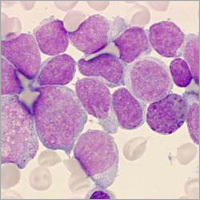 Acute Leukemia Ayurvedic Treatment