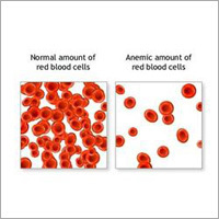 Anemia Ayurvedic Therapy