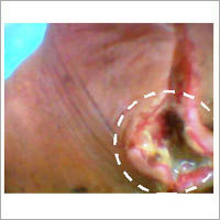 Diabetic Wounds Ayurvedic Medicine