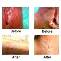 Diabetic Wounds Ayurvedic Treatments