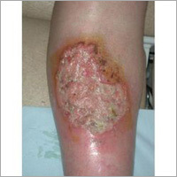 Non Healing Wounds Ayurvedic Therapy