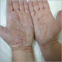 Ayurvedic Skin Disease Medicine