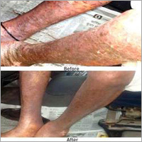 Skin Disease Ayurvedic Therapy