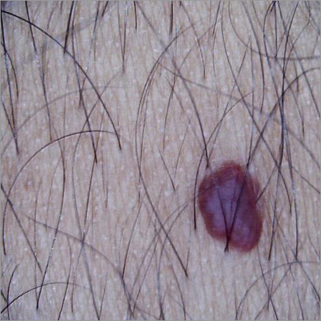 A small mole on the skin