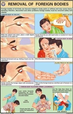 Removal of Foreign bodies Chart