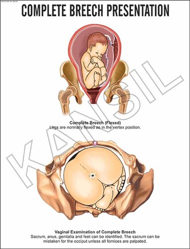 Complete Breech Presentation Chart