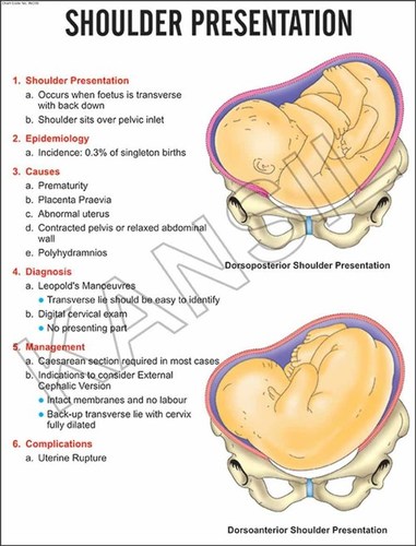 Shoulder Presentation Chart