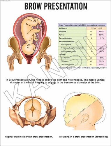 Brow Presentation Chart