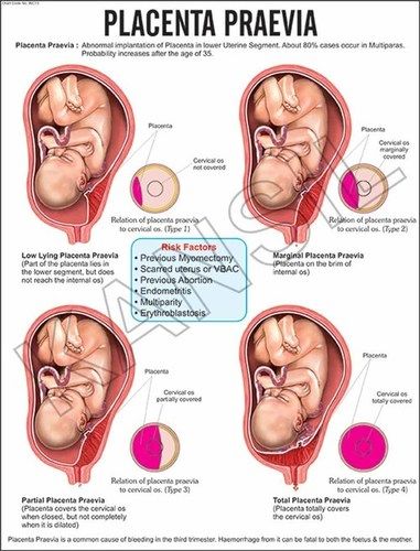 Placenta Praevia Chart