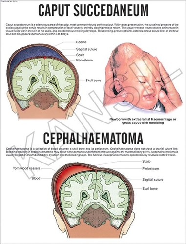 Caput Succedaneum, Cephalhaematoma Chart