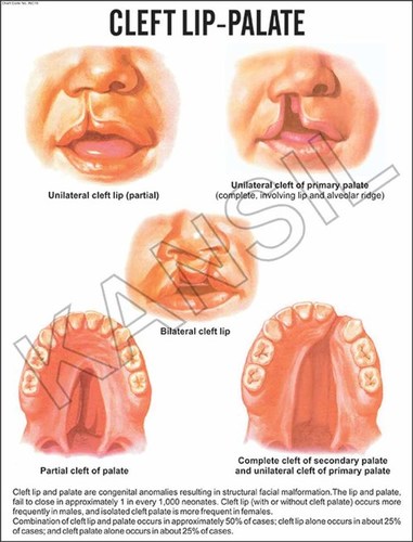 Cleft lip-Palate Chart