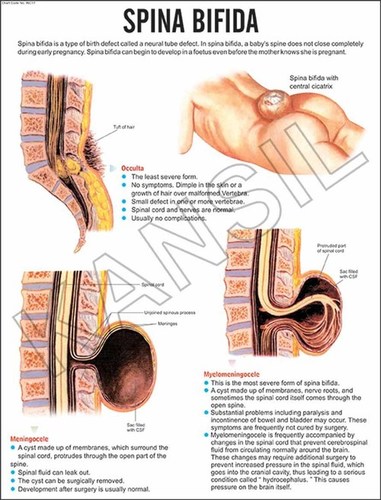 Spina Bifida Chart