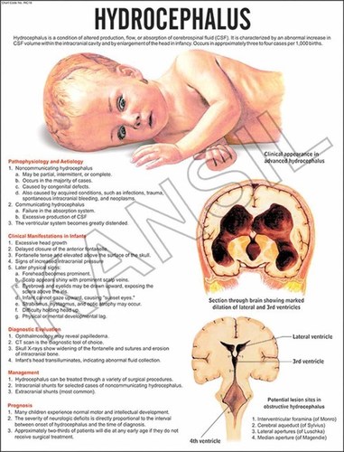 Hydrocephalus Chart