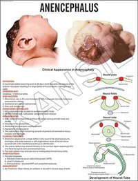 Anencephalus Chart