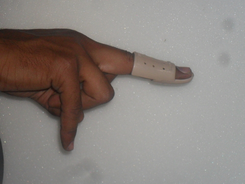 FROG SPLINT