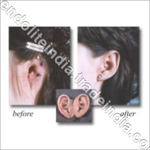 Prosthetic Ear