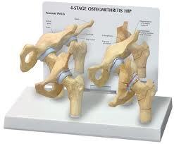 Easy To Remove Hip Osteoarthritis Model