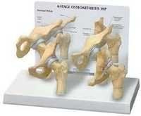 Hip Osteoarthritis Model