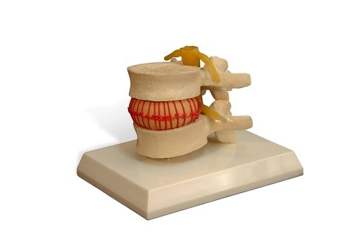 Disc Prolapse Simulator Model