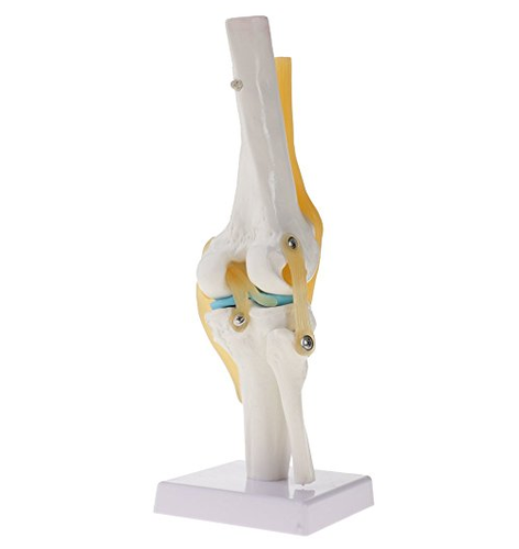 Easy To Remove Knee Arthritis Model