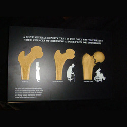 4 STAGE KNEE ARTHRITIS MODEL