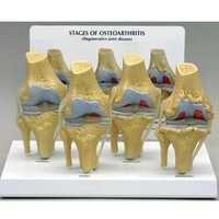 Knee Arthritis And Osteoporosis Model