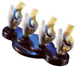 Four-Stage Osteoarthritis Knee Model