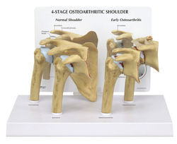 Shoulder Arthritis Model