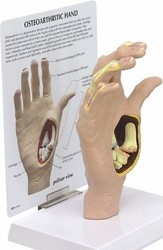 Hand Osteoarthritis Model